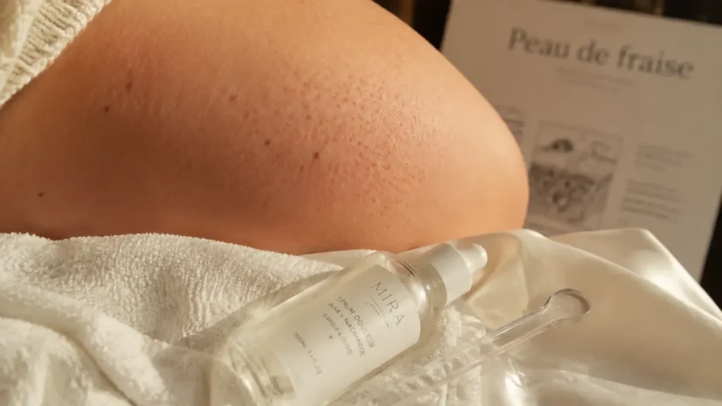Peau de fraise : comment la distinguer de la kératose pilaire, des poils incarnés et de la folliculite