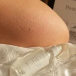 Peau de fraise : comment la distinguer de la kératose pilaire, des poils incarnés et de la folliculite